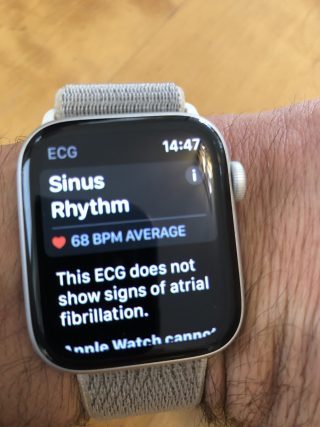 ECG Sinus Rhythm Result - no fibrillation